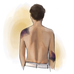 Illustration eines Oberkörpers mit sichtbaren Blutergüssen als Symbol für körperliche Verletzungen nach sexualisierter Gewalt.